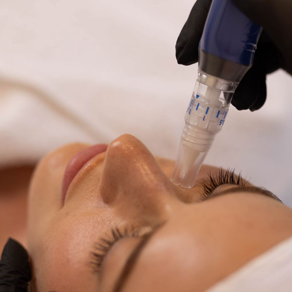 Glysal Säurepeeling